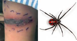 If you ever meet is, the golden rule is not to provoke it, and the insect will go away peacefully. 5 Year Old Girl Bitten By Black Widow Spider Myfox8 Com