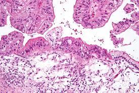 If the gp thinks your symptoms could be due to ovarian cancer, they'll recommend having a blood test to check for a substance called ca125. Ovarian Cancer Wikipedia