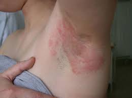Image result for dermatitis contacta