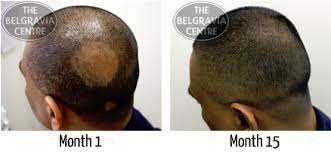 Welcome to hair loss experiences hair loss forum. Study Results Could Help Depression Related Hair Loss