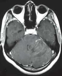 Dx Dysplastic Cerebellar Gangliocytoma A Axial T2wi Shows A Cerebellar Mass With A Striped Appearance Composed Of Alternating Hype Enhancement Tumor B Rain