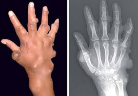 Https Www Dermatolarg Org Ar Index Php Dermatolarg Article Download 1251 735 8301