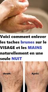 L'ongle incarné est provoqué par un fragment d'ongle qui pénètre dans la chair et provoque une inflammation et des douleurs. Voici Comment Enlever Les Taches Brunes Sur Le Visage Et Les Mains Naturellement En Une Seule Nuit Health And Wellness Health Wellness