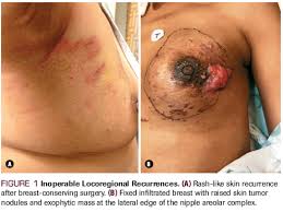What symptoms may occur, and what treatment options are available if your breast cancer spreads to your brain? Current Strategies For The Management Of Locoregional Breast Cancer Recurrence
