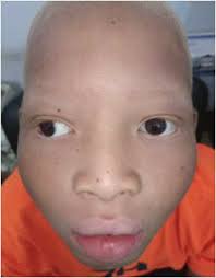 Genotypic spectrum of albinism in Mali