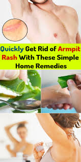 Quickly Get Rid Of Armpit Rash With These Simple Home Remedies Armpit Rash Armpits Remedies