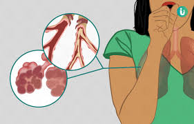 Global initiative for chronic obstructive lung disease (gold) website. Copd Chronic Obstructive Pulmonary Disease Symptoms Causes Treatment Medicine Prevention Diagnosis