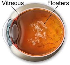 What causes floaters after cataract surgery. Eye Floaters Causes And Treatments Assil Eye Institute