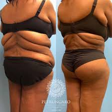 Check spelling or type a new query. 53 F Fleur De Lis Body Lift Lipo Bbl Petrungaro Plastic Surgery