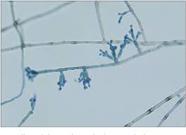 Thoroughly studying the pathogenic mechanism of fonsecaea pedrosoi is beneficial for the exploration and therapy for this fungal infection. Figure 5 From Chromoblastomycosis Caused By Fonsecaea Pedrosoi Semantic Scholar