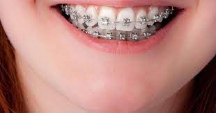 how to get teeth fixed without braces gap teeth fix teeth perfect teeth