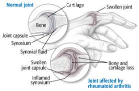 Rheumatoid Arthritis Guide Causes Symptoms And Treatment Options