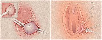 How do i get rid of a boil on my vagina? Vaginal Pimples Causes Of Pimple In Or Near Vaginal Area On Vaginal Lip