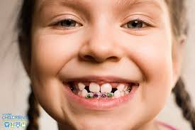 When little ellie clay had a loose tooth, her father found a novel way to pull it out. How Early Should Childrens Braces Be Put On The Teeth