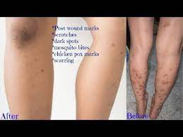 New scars have a pink to reddish colour. Pin On Beauty Basics