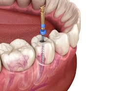Wurzelbehandlung kann bei zahnentzündung die letzte chance sein in den meisten fällen ist karies dafür verantwortlich, wenn die zahnwurzel behandelt werden muss. Wurzelbehandlung Parastu Toutian