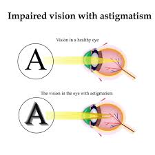 Strabismus can occur at any age, but is most common in infants and young children. How To Naturally Improve Poor Vision Caused By Astigmatism