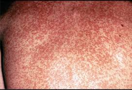 Rubella Picture Image On Medicinenet Com