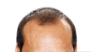 Ai 20 anni è soggetto ad una precoce (o precocissima) perdita dei capelli. La Stempiatura Di Harry Styles Si Tratta Di Alopecia Androgenetica