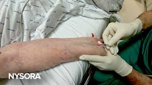 Image result for Peripheral IV Access