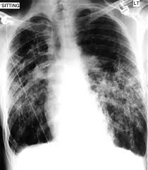 It occurs when air accumulates between the parietal and visceral pleurae inside the chest. The Point Of The Needle Occult Pneumothorax A Review Emergency Medicine Journal