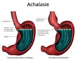 Achalasie