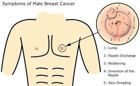 Some men develop rarer types of breast cancer, such as inflammatory breast cancer. Being A Man Does Not Make You Immune To Breast Cancer