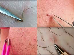 It is common after shaving your underarms and it usually disappear on its own. These Are The Best Most Satisfying Ingrown Hair Removal Videos On The Internet Ingrown Hair Removal Ingrowing Hair Ingrown Hair