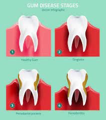 Pin On Gum Treatment