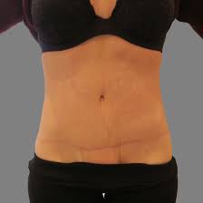 Weightloss with tummy tuck surgery; The Plastic Surgery Group Abdominoplasty