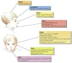 Characteristics Fetal Alcohol Syndrome Characteristics
