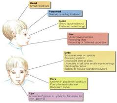 characteristics fetal alcohol syndrome characteristics