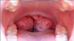 Rarely, it is caused by other viruses, such as cytomegalovirus (cmv). Test Per La Mononucleosi Esami Clinici Come Riconoscere La Mononucleosi