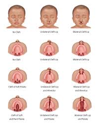 Image result for Cleft Lip