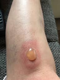 Image result for große winkelspinne biss haut reaktion