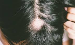Alopecia is hair loss or balding. Alopecia Areata What You Need To Know Miami Hair Institute