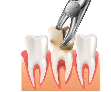 Tooth Extraction product image