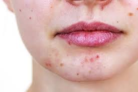 Physical scrubbing can actually create more aggravation and redness. Yes Pregnancy Can Cause Acne But There Are Safe Ways To Treat It