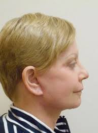 Plastic Surgery Testimonials In NYC