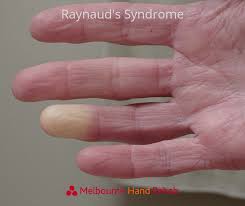 What do numb fingertips mean? Raynaud S Disease Cold White Fingers Melbourne Hand