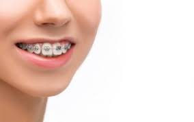 The type of treatment your orthodontist recommends can create an even more specific patients requiring minimal or basic straightening wear braces for a shorter time. Second Time Braces Second Round Of Orthodontic Treatment