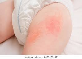 Image result for diaper dermatitis