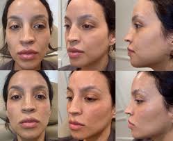 Lip augmentation using 0.8mL Restylane Kysse 💋 #lipfillers  #lipfillerbeforeandafter #aesthetics #desmoinescosmetics #iowa