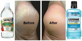 How To Fix Cracked Feet Fast Dry Feet Remedies Health And Beauty Tips Foot Remedies