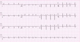 Atrial Fibrillation Ecg Classification Causes Risk Factors Management Ecg Echo