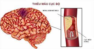 Hàm lượng lycopene cao được tìm thấy trong cà chua, có thể làm giảm đáng kể nguy cơ đột quỵ. Sá»± Hinh Thanh Cá»¥c Mau Ä'ong Trong Nao Nguyen Nhan Hang Ä'áº§u Gay Ä'á»™t Quá»µ Vinmec