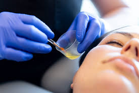 Chemical Peel