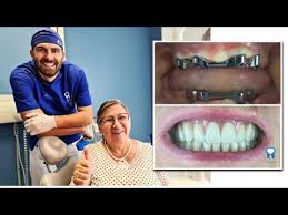 Proteza Na 4 Implantata Proteza Na Precki Video Blog 4smile