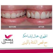اظهري جمال ابتسامتكـ مع قص اللثة بالليزر لدى مجمع عيادات بيرل Medical Technology Convenience Store Products Pill
