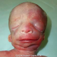 Dysostosis mandibulofacialis) ist eine erbliche erkrankung, die zu gesichtsfehlbildungen (craniofaziale dysmorphie) führt. Treacher Collins Syndrome Role Of 3d 4d Ultrasound In The Assessment Of Fetal Facial Dysmorphism Html